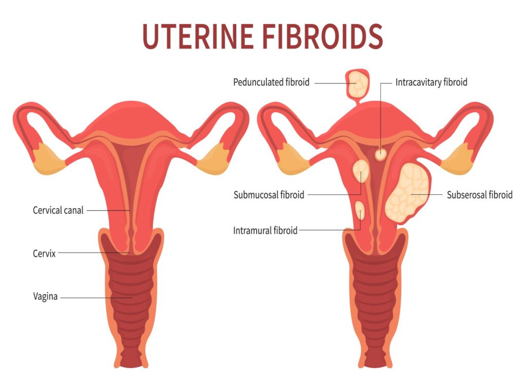 Uterine Fibroids